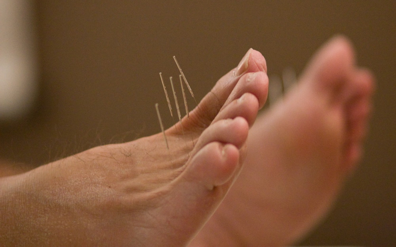 acupunctuur met naalden